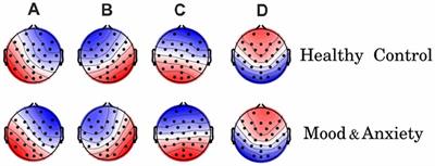 EEG Microstates Temporal Dynamics Differentiate Individuals with <mark class="highlighted">Mood and Anxiety Disorders</mark> From Healthy Subjects
